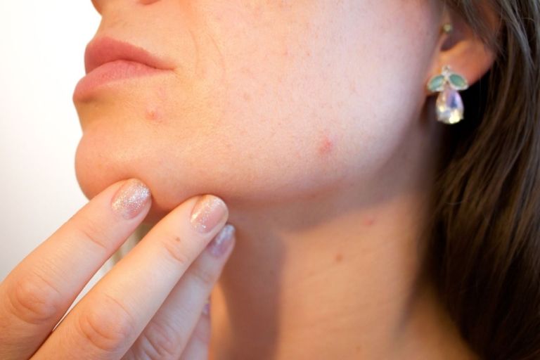 Cómo tratar el acné con productos naturales?